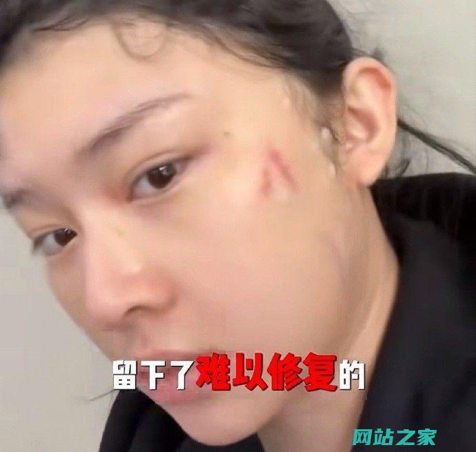 网红祖宗娜自曝整容失败拒造假宣传遭医美机构拘